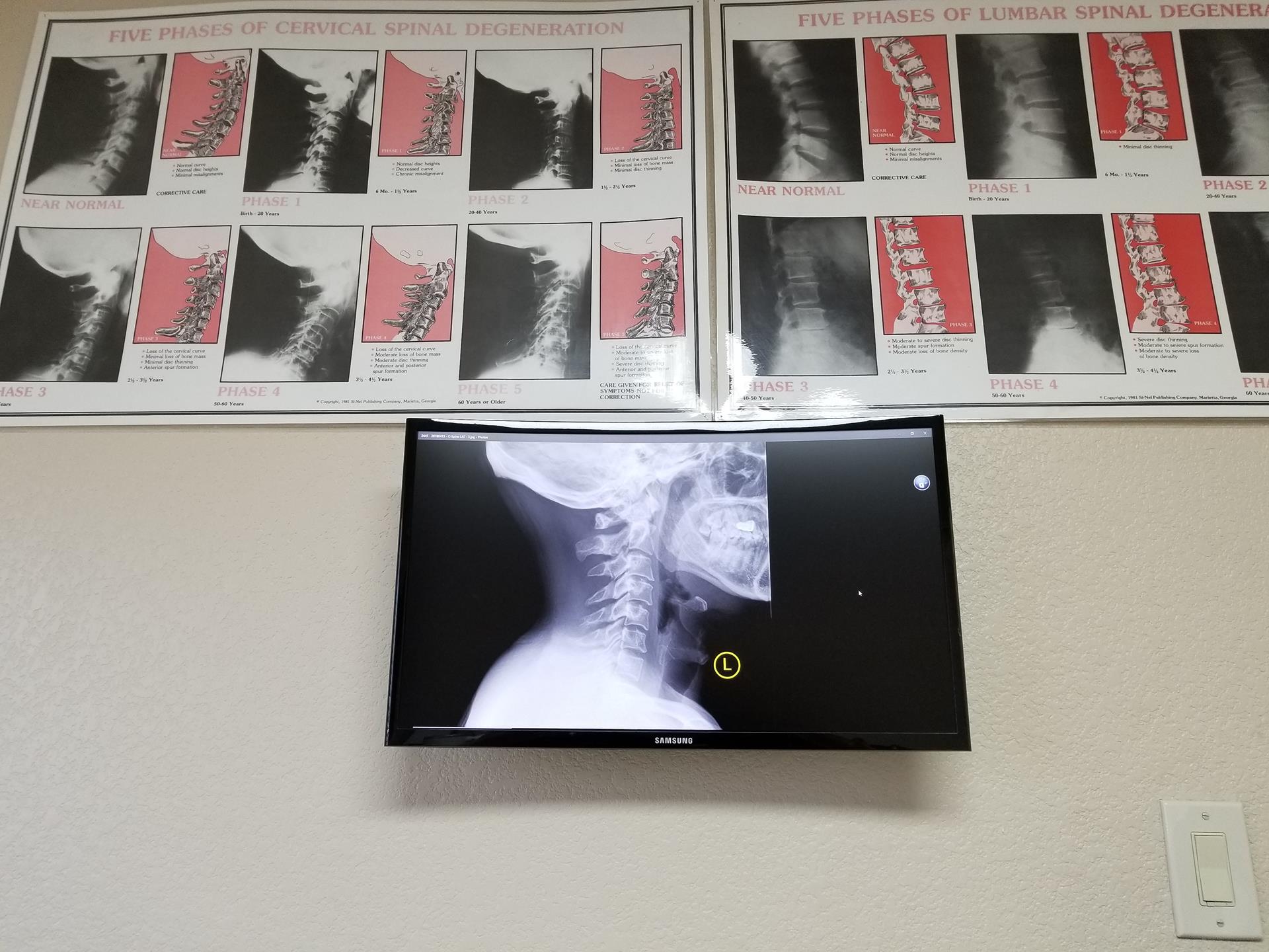 In-office X-ray display showing spinal anatomy